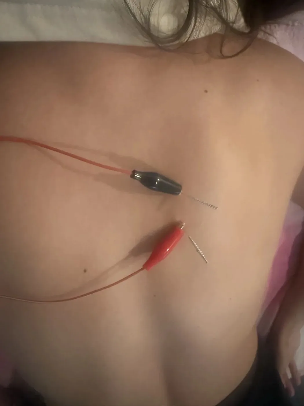Two dry needles seated in the thoracic paraspinals with red and black e-stim alligator clips attached, showing the electrical dry needling setup used by Dr. Andrew Cisneros at Solas Physical Therapy in El Paso